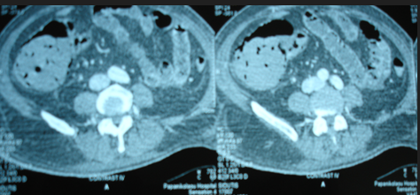 Abdominal CT Scan. Bowel pneumatosis