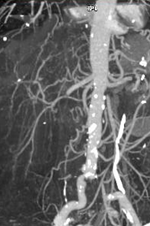 Aortic arteriography. Thrombosis of the origin of the celiaco-mesenteric trunk