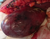 Ischaemic changes of gallbladder and omentum major (majus)