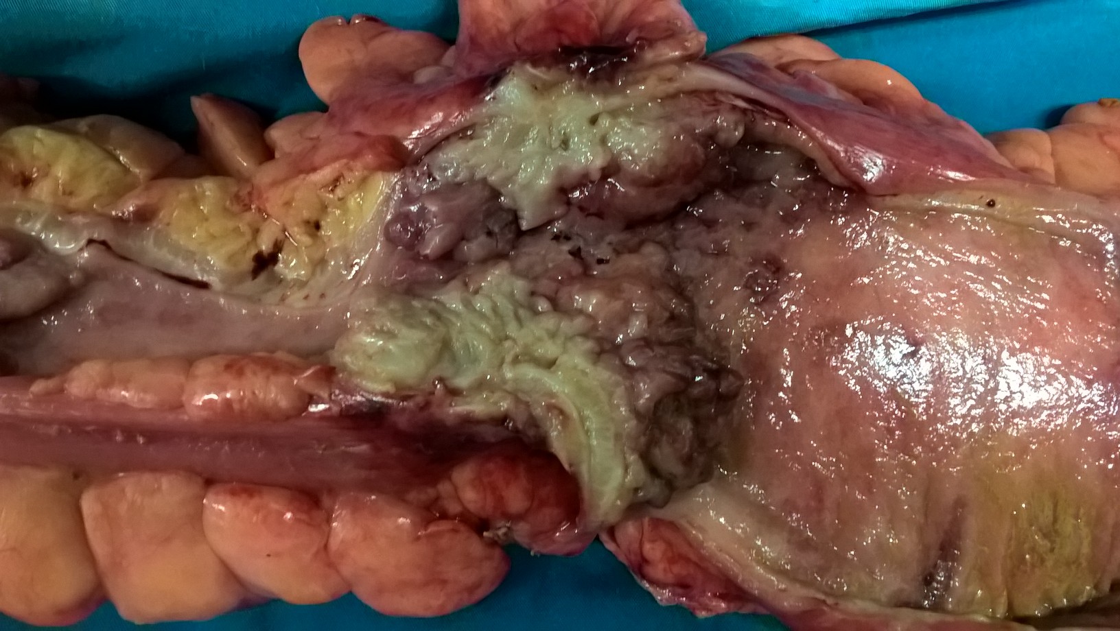 Αδενοκαρκίνωμα του παχέος εντέρου