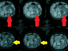CT κοιλίας. Ρήξη του αριστερού νεφρικού παρεγχύματος και μεγάλου μεγέθους οπισθοπεριτοναϊκό αιμάτωμα