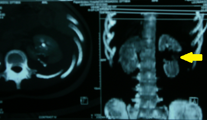 Ανασύνθεση CT. Πλήρης διχοτόμηση του αριστερού νεφρού