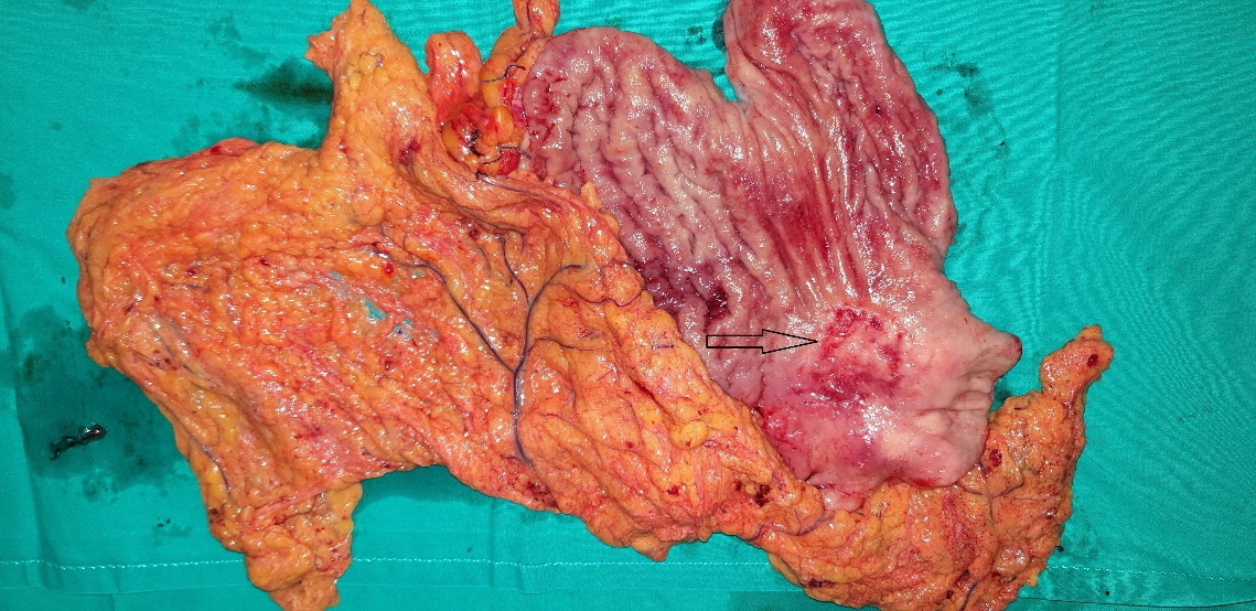 Παρασκεύασμα ολικής γαστρεκτομής. Καρκίνος στομάχου (μπλε βέλος)