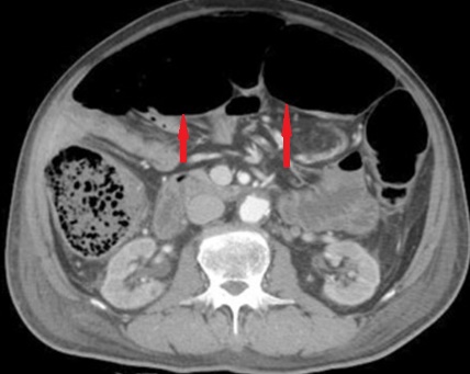 CT κοιλίας. Διάταση εγκαρσίου κόλου στα 9,8 cm