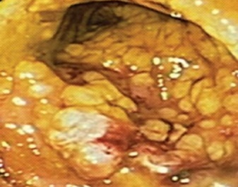 Εικόνα κολονοσκόπησης συμβατή με ψευδομεμβρανώδη κολίτιδα