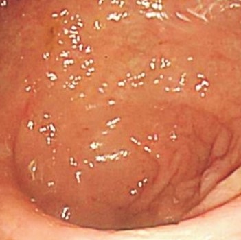 Κολονοσκόπηση παρακολούθησης  φυσιολογικός βλεννογόνος