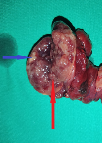 Red arrow - follicular thyroid carcinoma. Blue arrow - papillary thyroid carcinoma