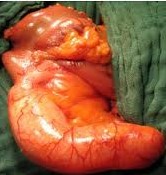 Βλεννώδες κυσταδένωμα