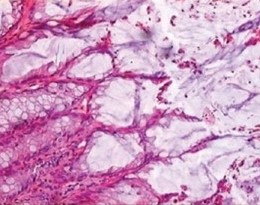 Ιστολογικά ευρήματα βλεννώδους κυσταδενώματος της σκωληκοειδούς. Κυλινδρικό επιθήλιο και παραγωγή βλέννης. Σημειώστε την απουσία ατυπίας και μιτωτικών μορφών