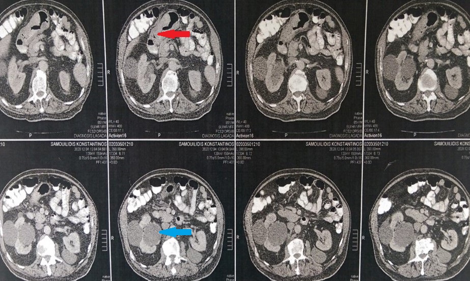CT Scan. The gastric tumors are obvious (red arrow). Incidental finding right sided sizable renal cysts (blue arrow)