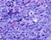 Neuroendocrine carcinoma (NEC) consisting of poorly differentiated tumor cells with many mitosis forming solid sheets and nests