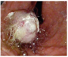 Endoscopical and CT Scan images of gastric tumors