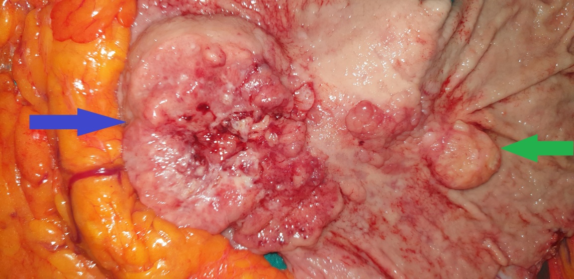Gastrectomy specimen. Green arrow - Mucus Adenocarcinoma. Blue arrow - Neuroendocrine Carcinoma