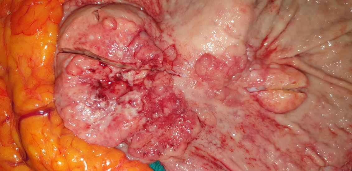 Cut surface of the tumors