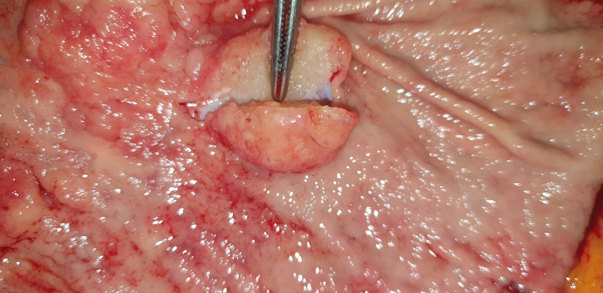 Detailed macroscopic view of mucus adenocarcinoma