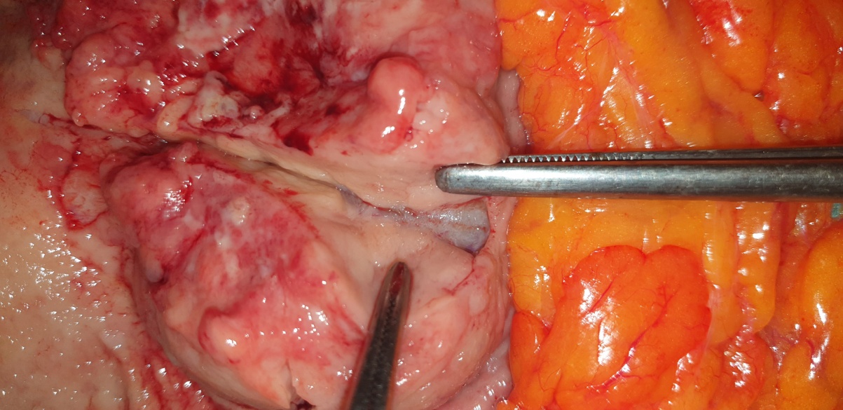 Detailed macroscopic view of neuroendocrine carcinoma