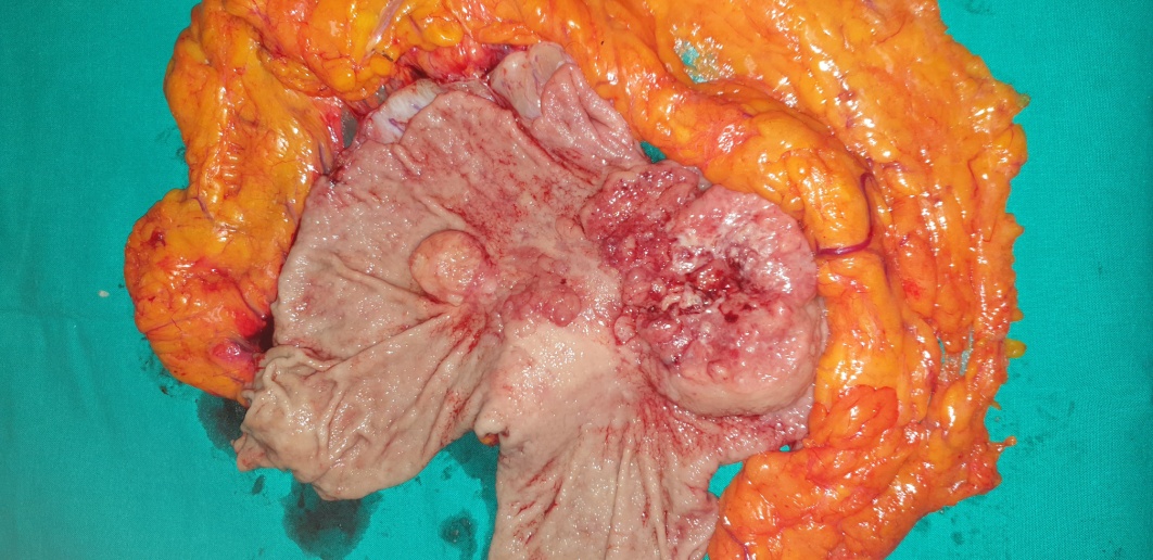 Total gastrectomy specimen
