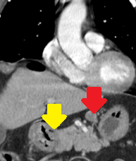Endoscopical and CT Scan images of gastric tumors