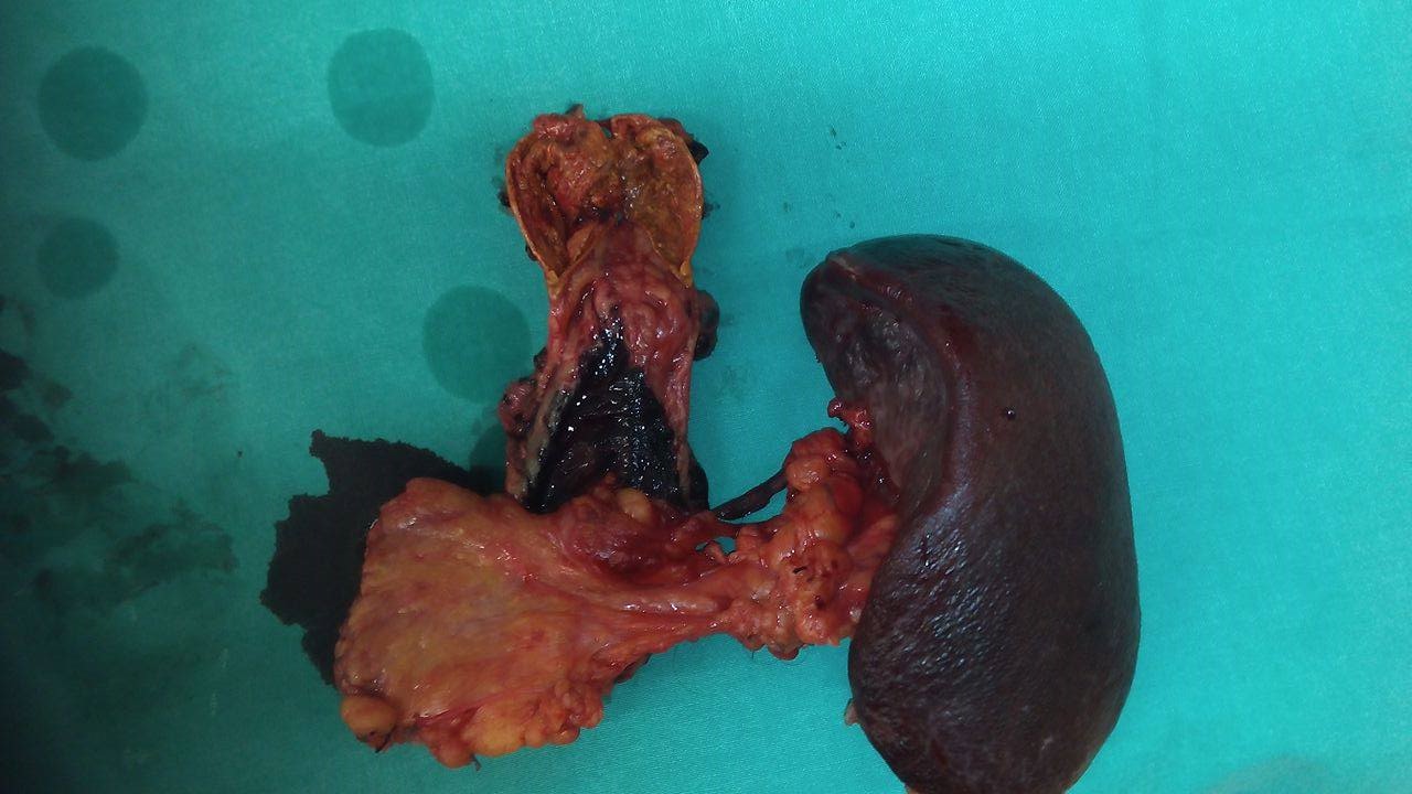 Μη λειτουργικό επινεφριδιοφλοιικό αδένωμα