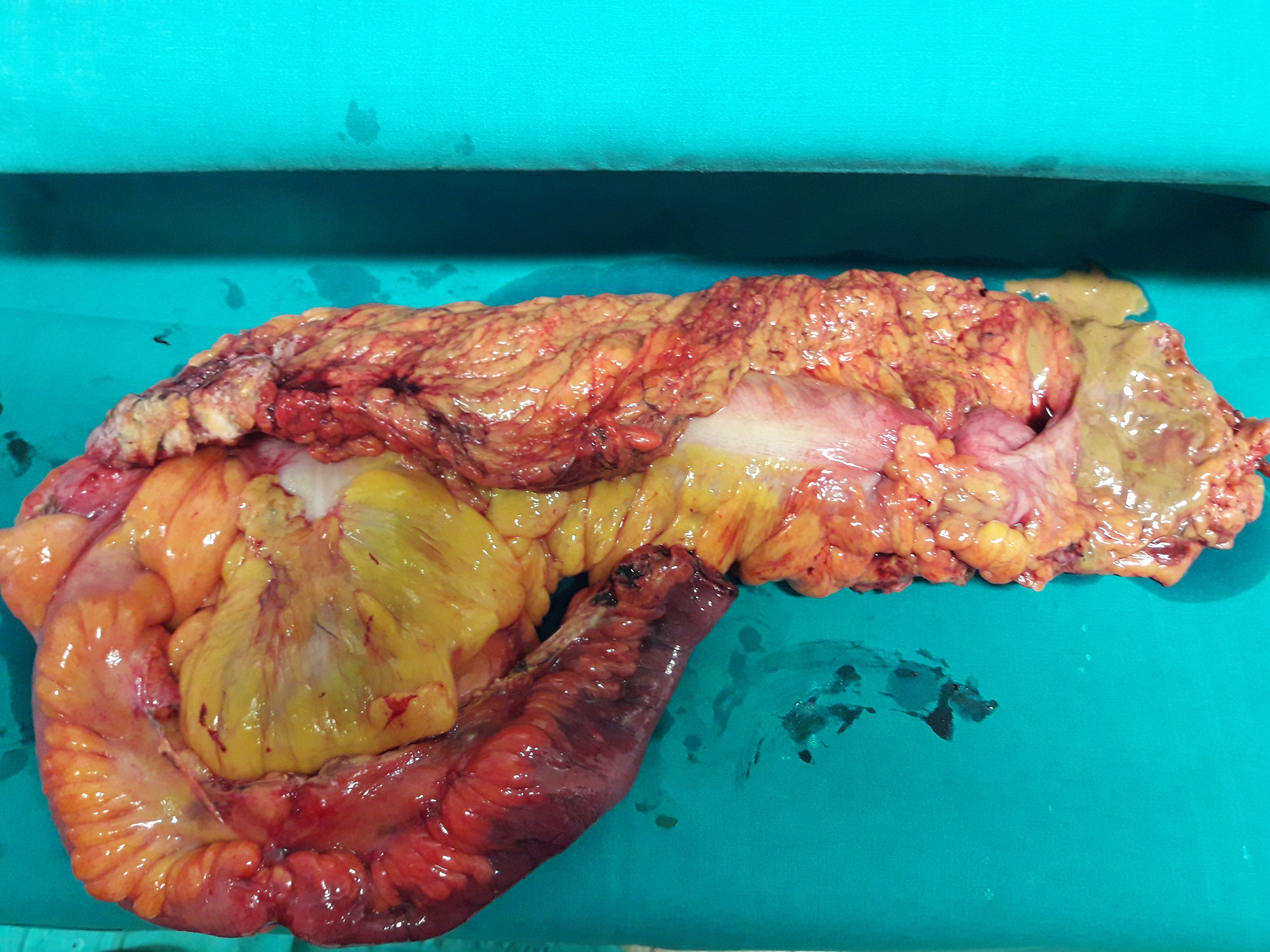 Ενδοαυλική μετάσταση παχέος εντέρου