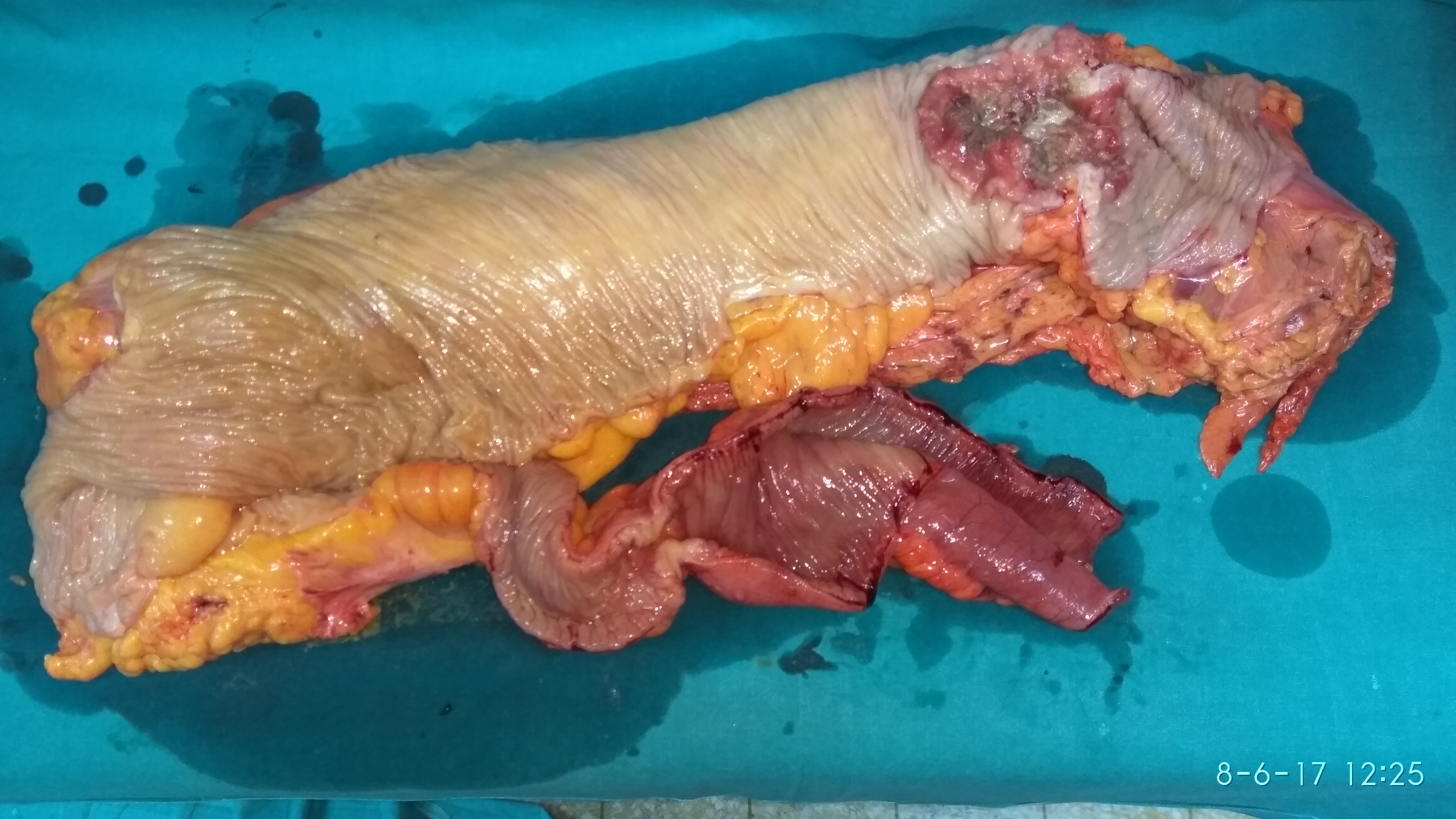 Ενδοαυλική μετάσταση λεπτού εντέρου