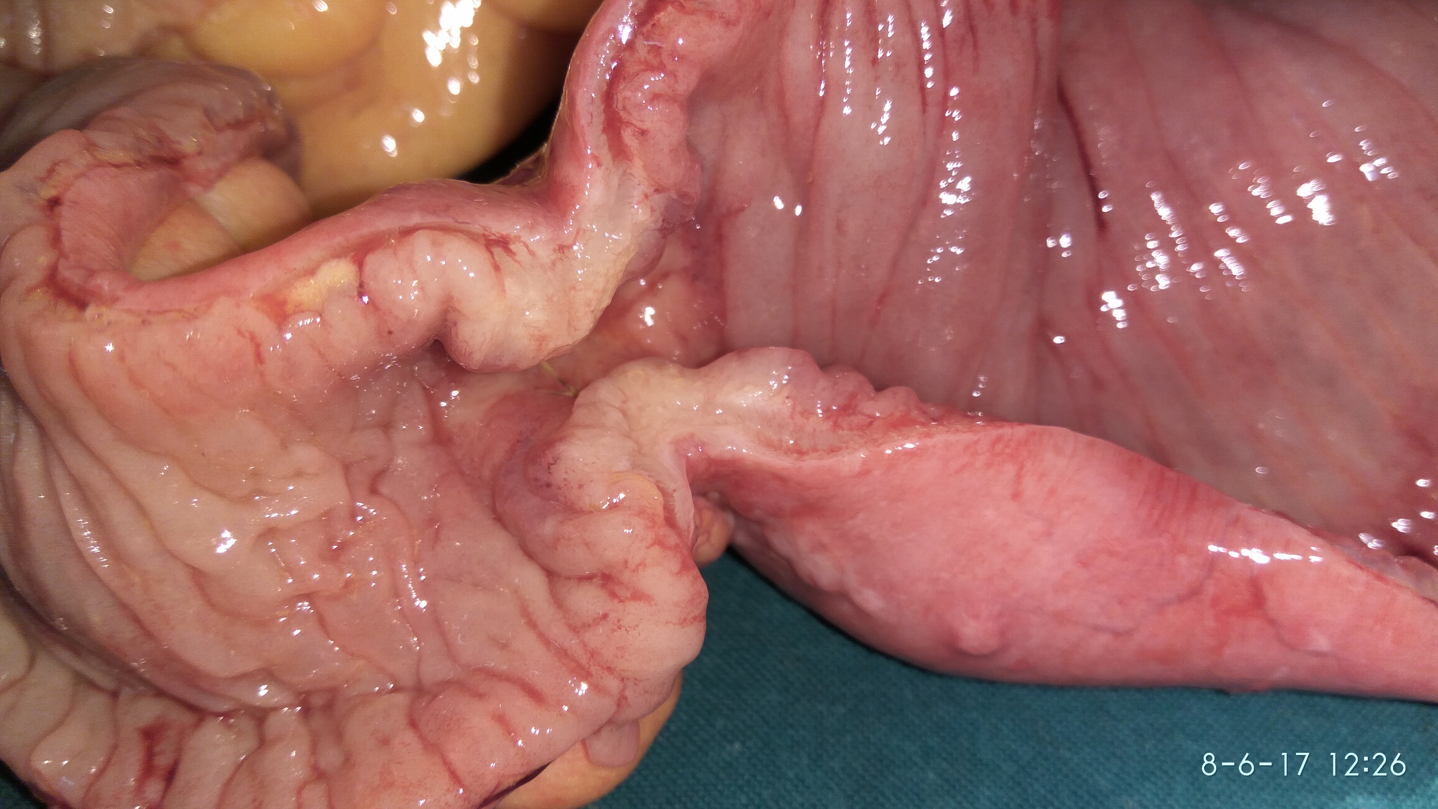 Ενδοαυλική μετάσταση λεπτού εντέρου