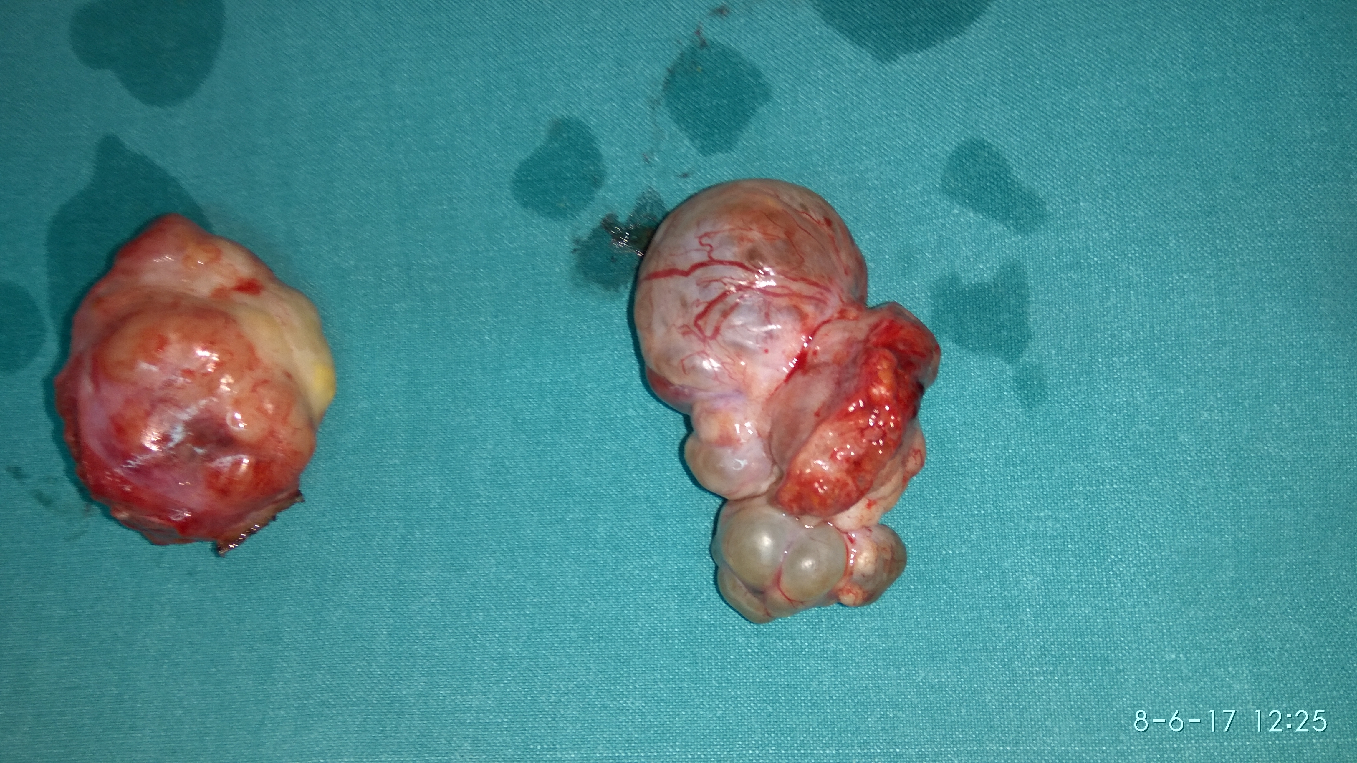 Αμφοτερόπλευρα καρκινώματα ωοθηκών