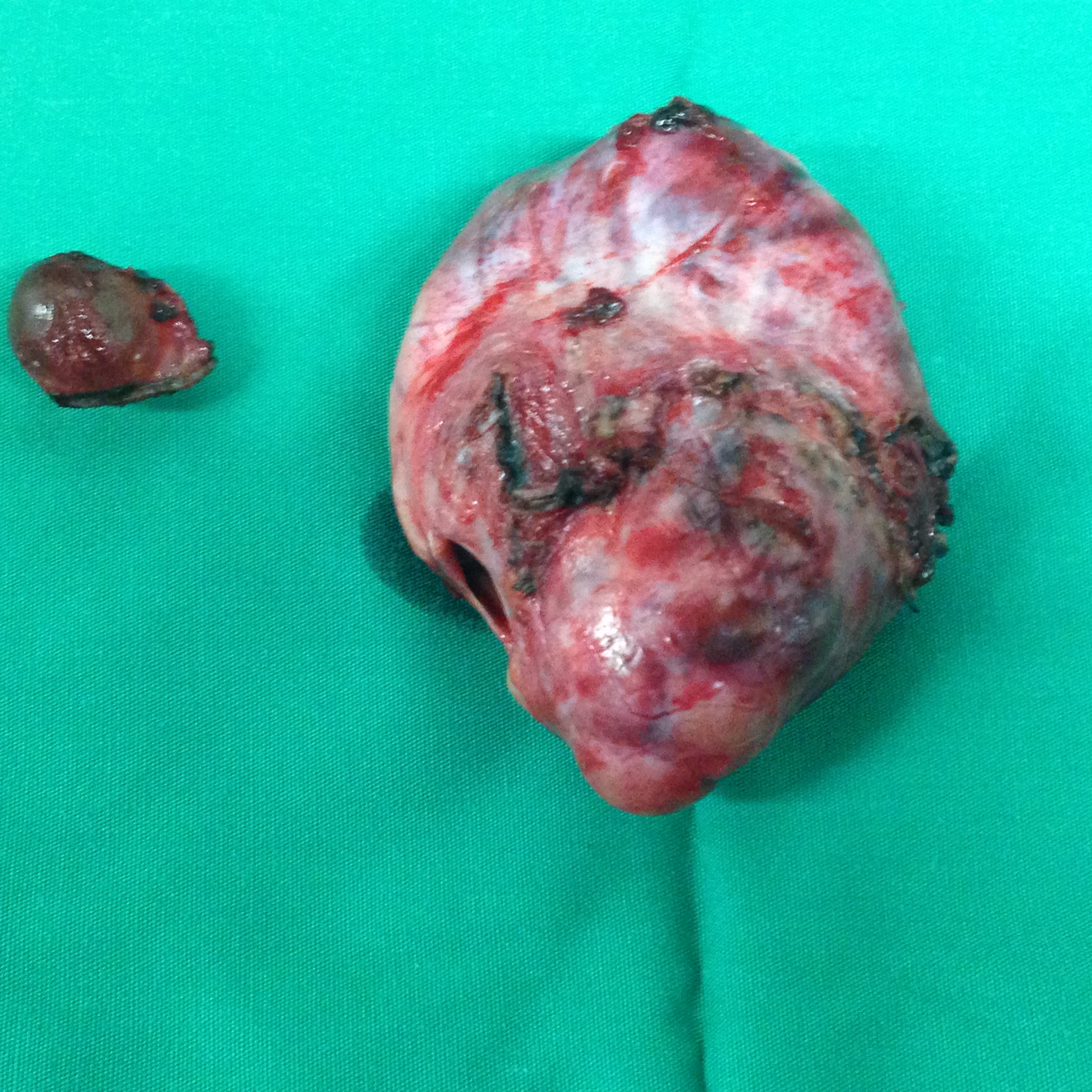 Αμφοτερόπλευρα καρκινώματα ωοθηκών