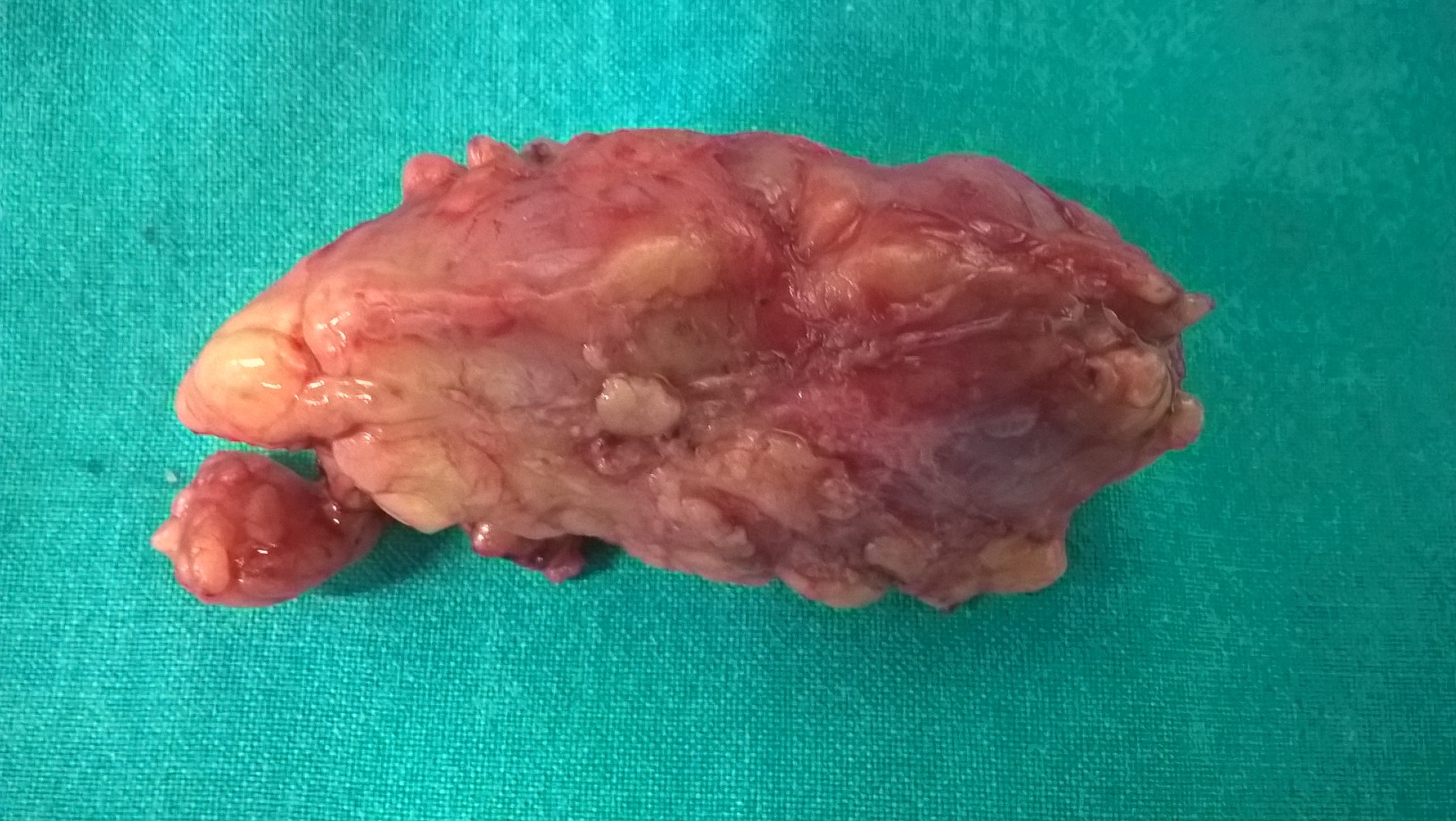 Αφαιρεθέντες αριστεροί βουβωνικοί λεμφαδένες