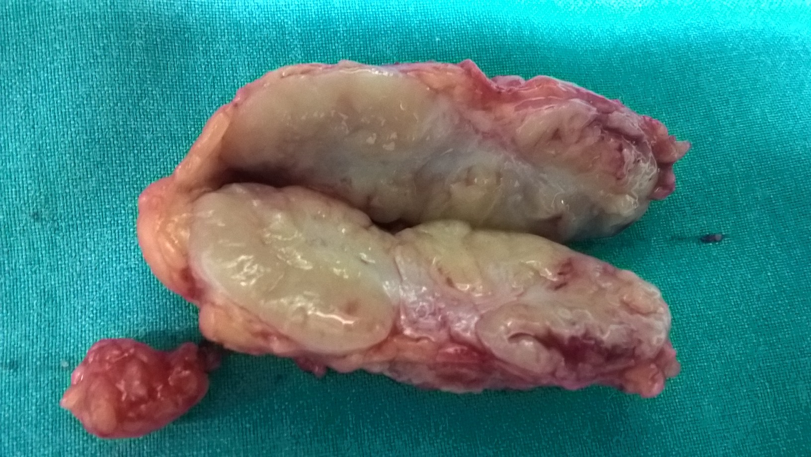 Αφαιρεθέντες αριστεροί βουβωνικοί λεμφαδένες