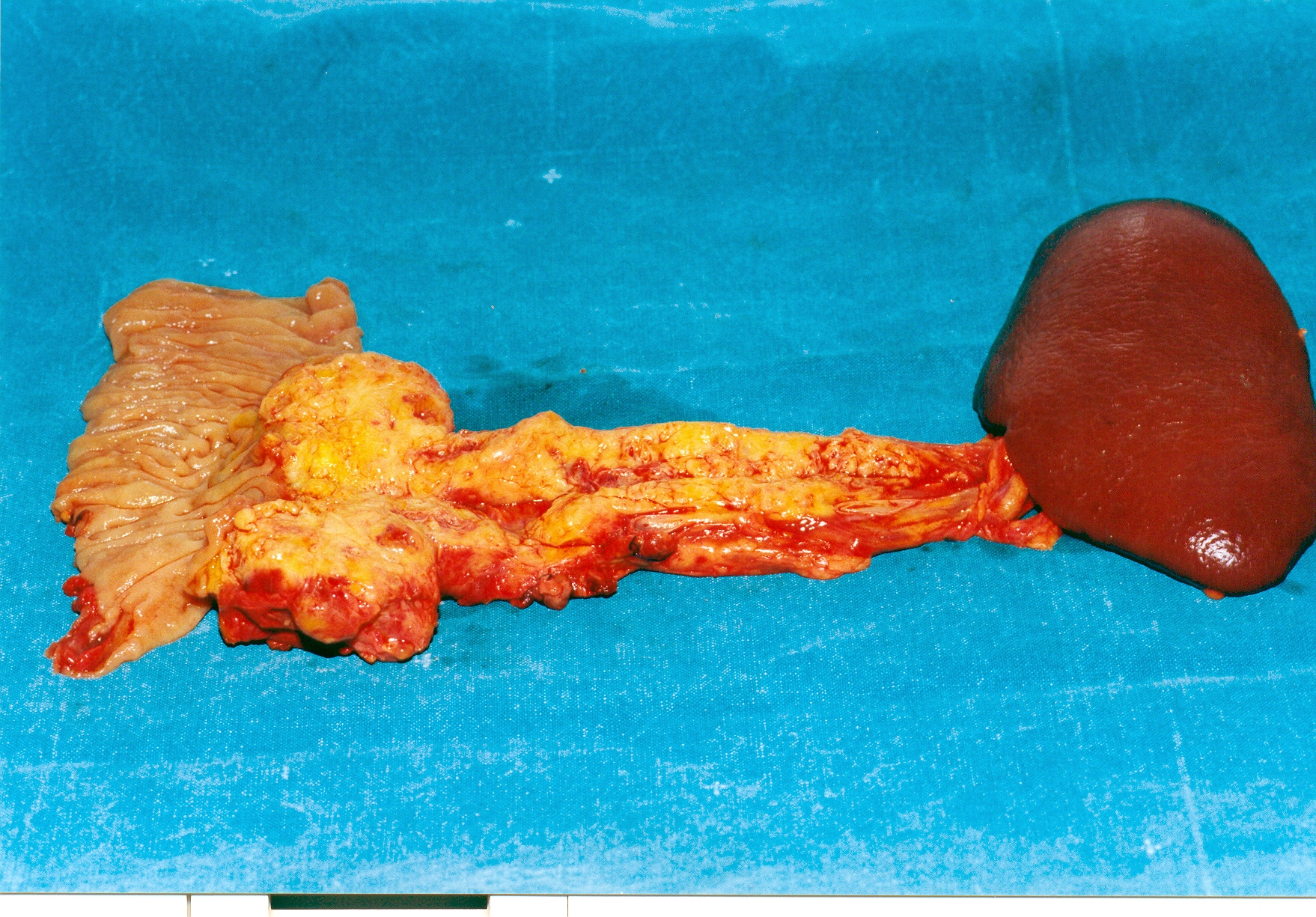 Total pancreatectomy specimen