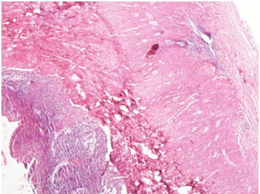Focus of stromal endometriosis in outer muscle layer of ileum
