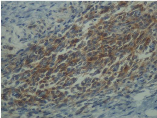 Positive CD10 immunostaining in endometriotic stromal cells