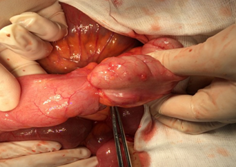 The small bowel obstruction (terminal ileum) is obvious