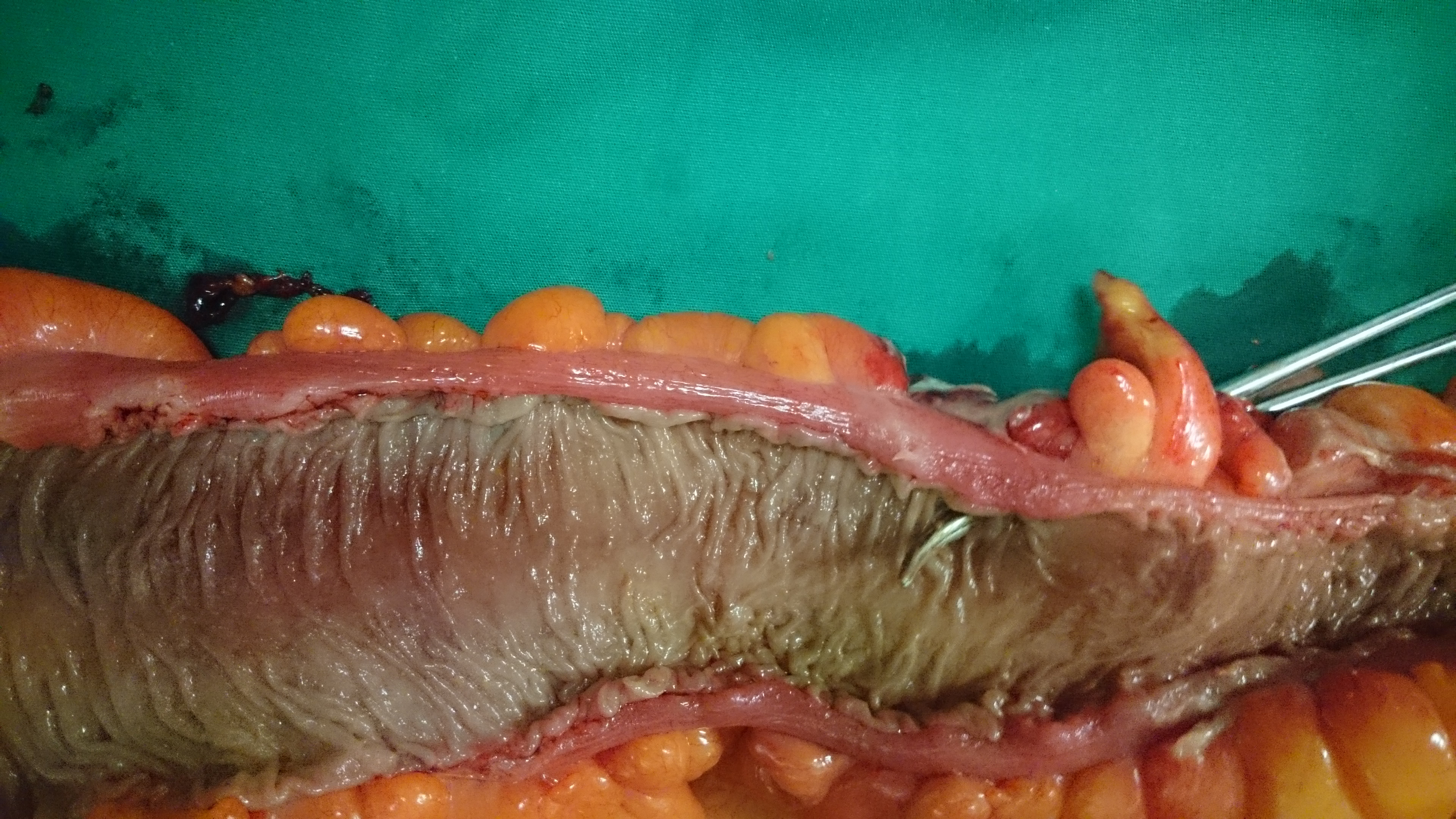 Αφαιρεθέν ορθοσιγμοειδές. Η θέση του διατρημένου εκκολπωματικού αποστήματος είναι εμφανής