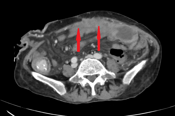 The malignant infiltration of the anterior abdominal wall is obvious
