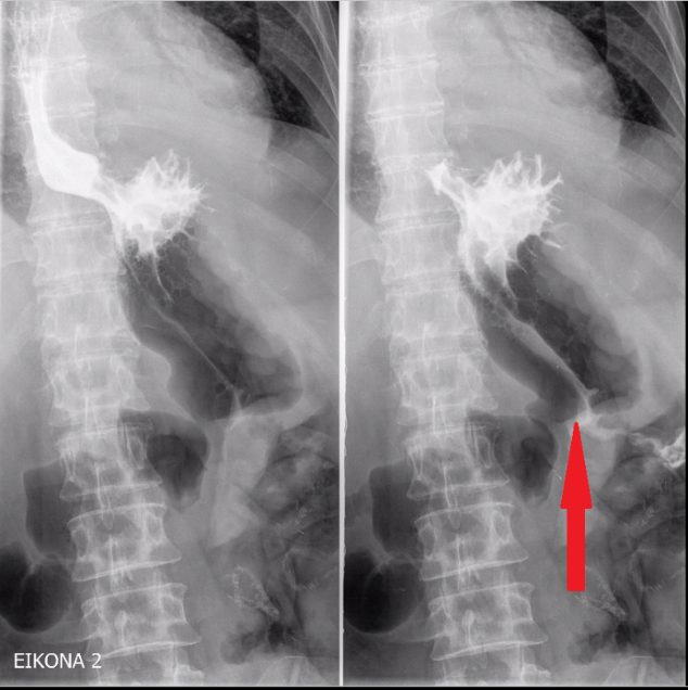 Gastrografin swallow examination. Gastric perforation