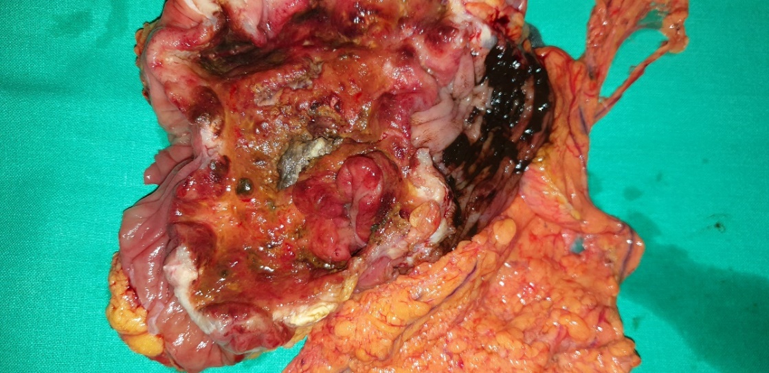 Specimen cut surface. The extend of the colonic carcinoma is obvious