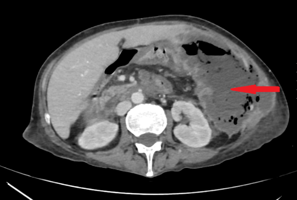 Large fluid collection in the left side of the abdomen with multiple air bubbles