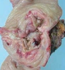 Καρκινωματώδης διάτρηση