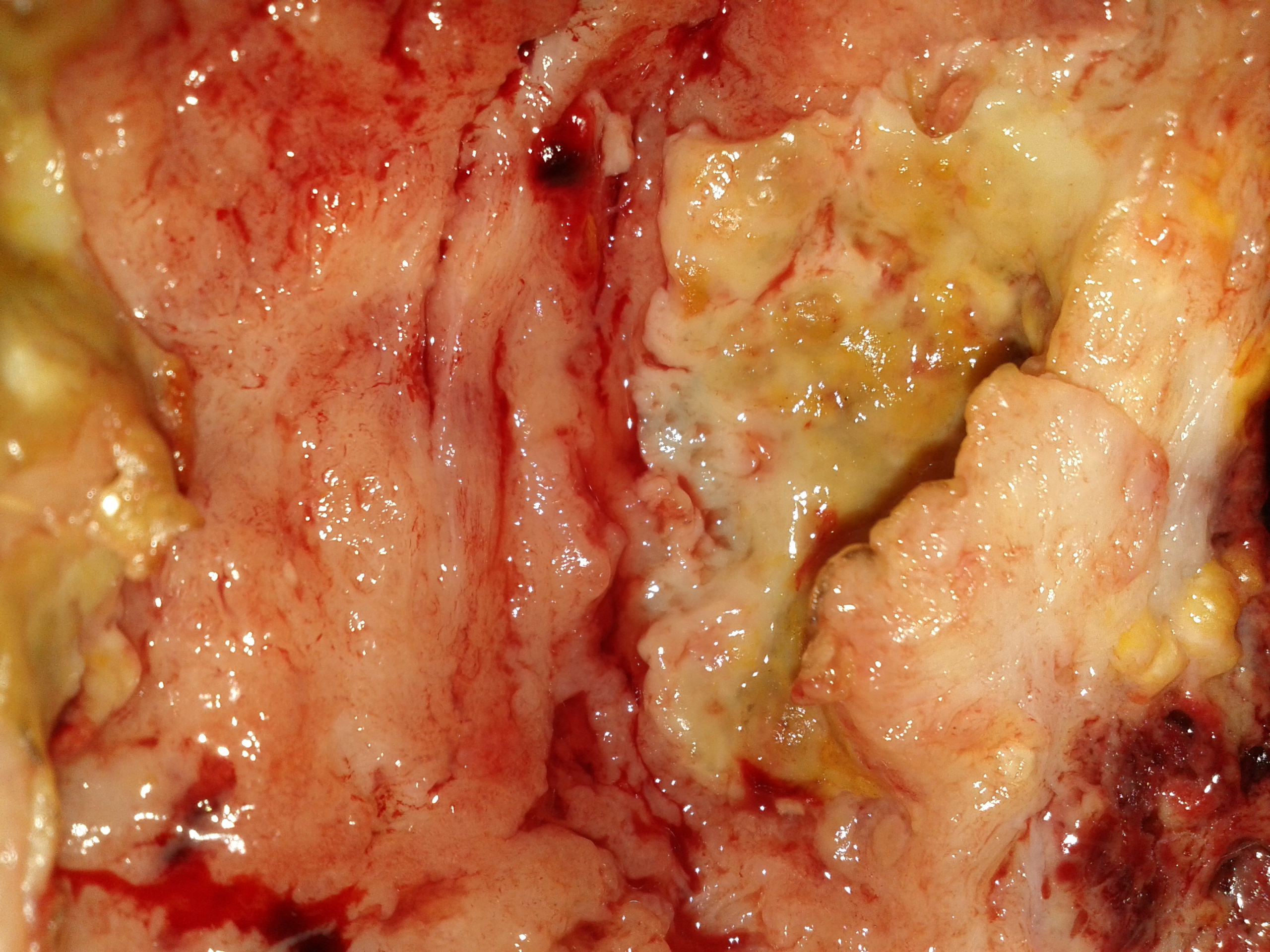 Διάτρηση από λέμφωμα