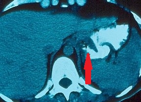 Abdominal CT Scan demonstrating the fistula between stomach and retroperitoneum