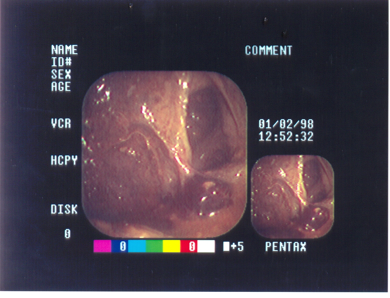 Ενδοσκοπικές λήψεις εξωπεριτοναϊκού ρήγματος ορθού