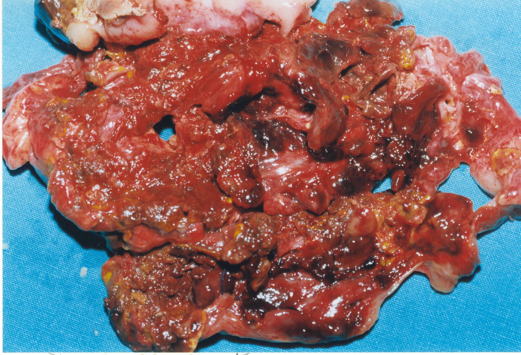 Non-traumatic adrenal haemorrhage (chloroma)