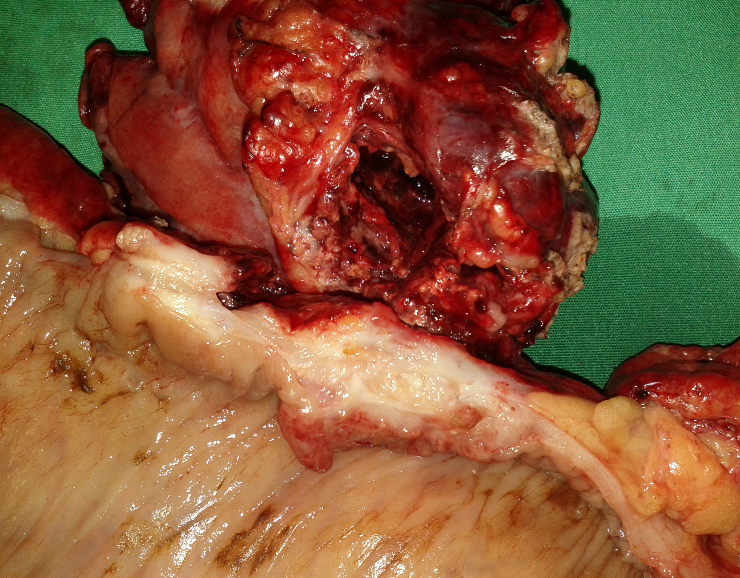 Colonic carcinoma in contact with the splenic abscess cavity