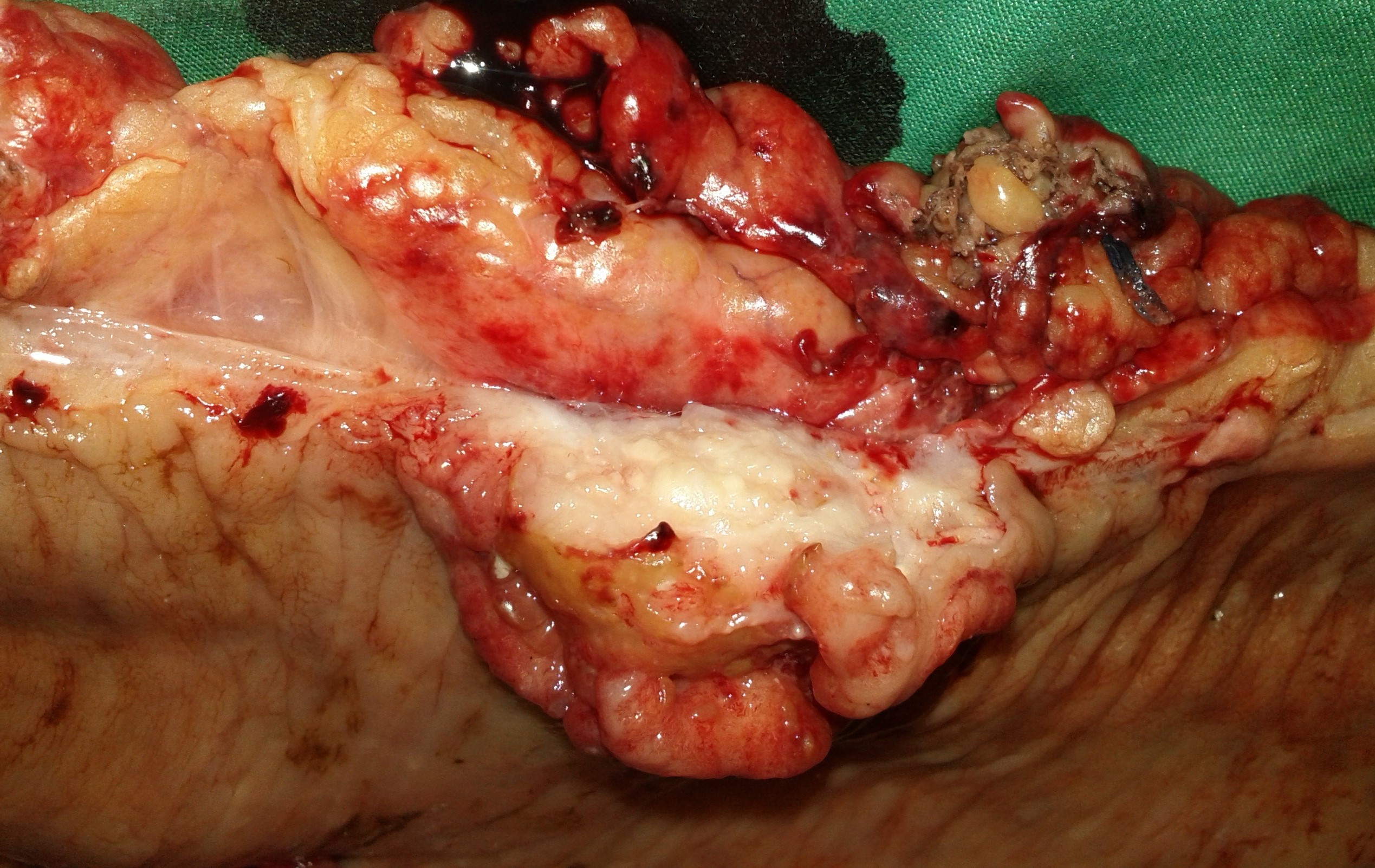 Colonic carcinoma