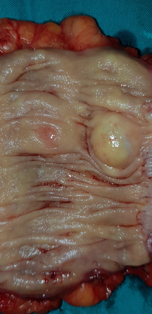 Παρασκεύασμα κολεκτομής