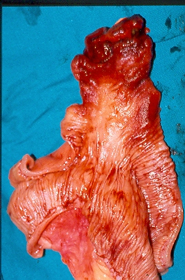 The vascular bleeding tumor is evident