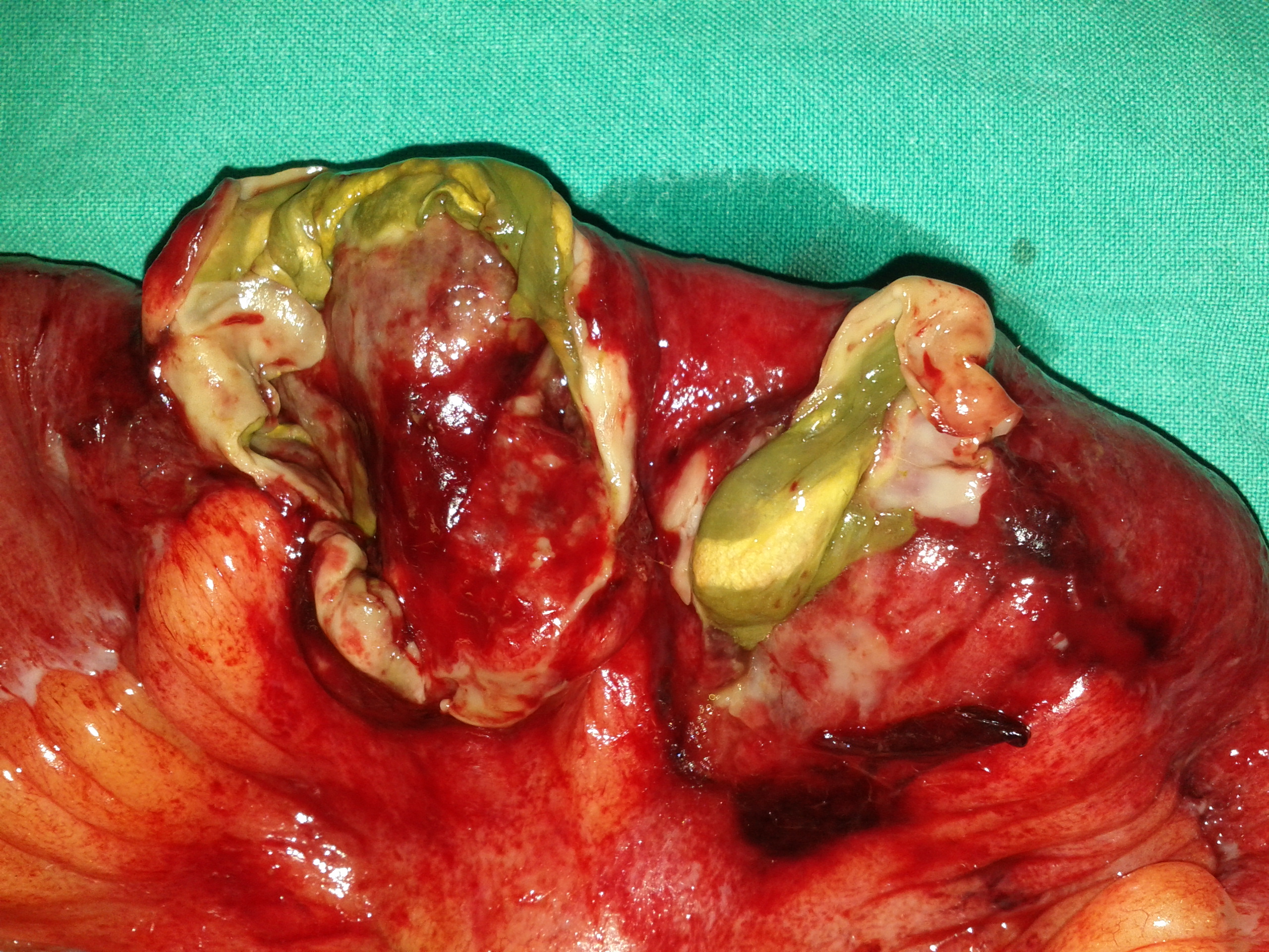 The perforation site of the terminal ileum is evident