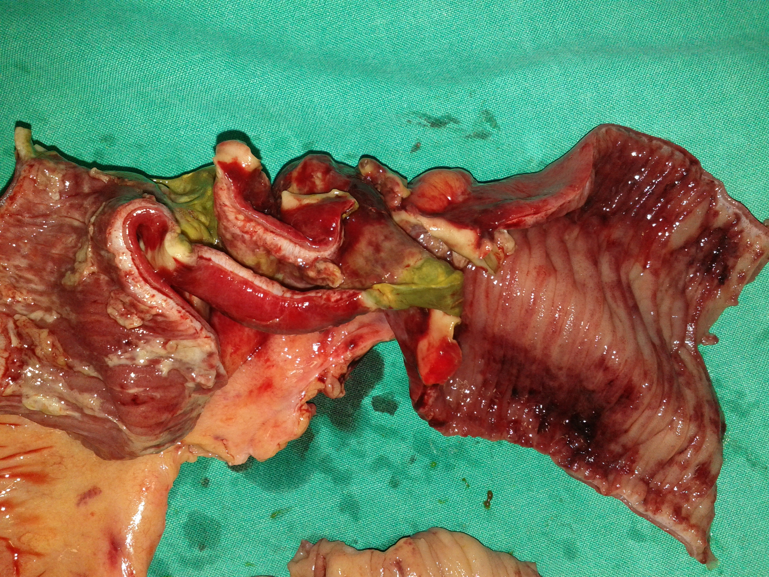 The perforation site of the terminal ileum is evident
